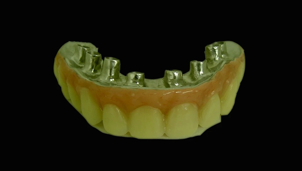 Prótesis híbida sobre implantes